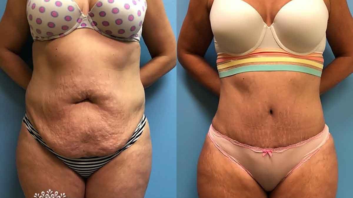 Tummy Tuck and Bilateral Liposuction to Hips - Case #44473 - The Plastic  Surgery Group