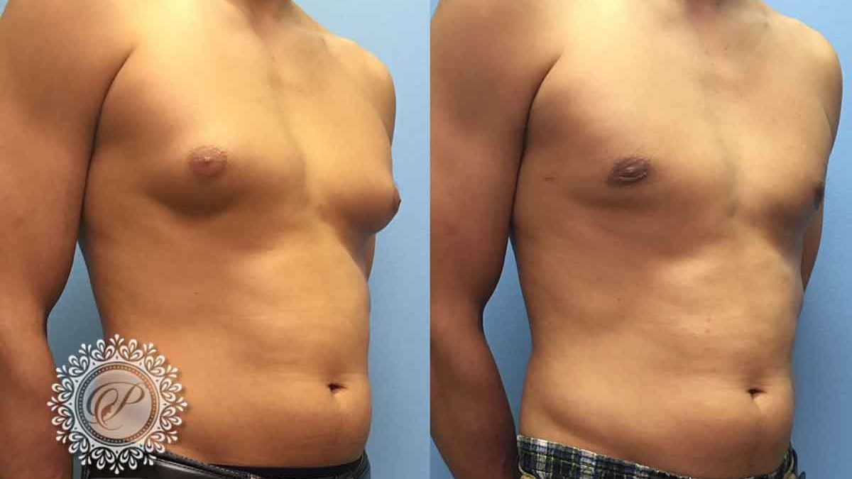 Gynecomastia Before & After Gallery: Patient 108