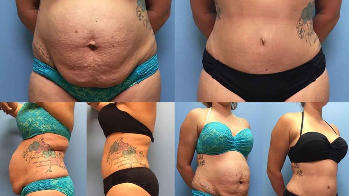 https://www.petrungaroplasticsurgery.com/wp-content/uploads/2019/09/cropped-before-after-tummy-tuck-with-liposuction-8.jpg