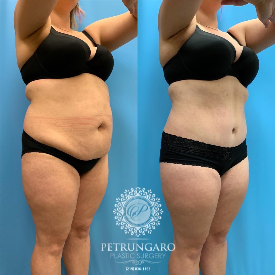 33-female-before-after-tummy-tuck-lipo-360-2