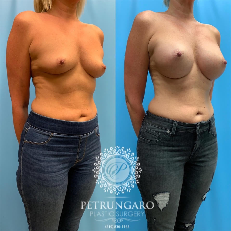 40-before-after-breast-augmentation-implants-2