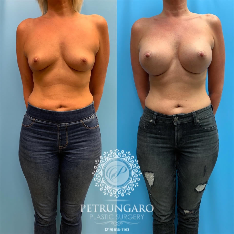 40 Before After Breast Augmentation