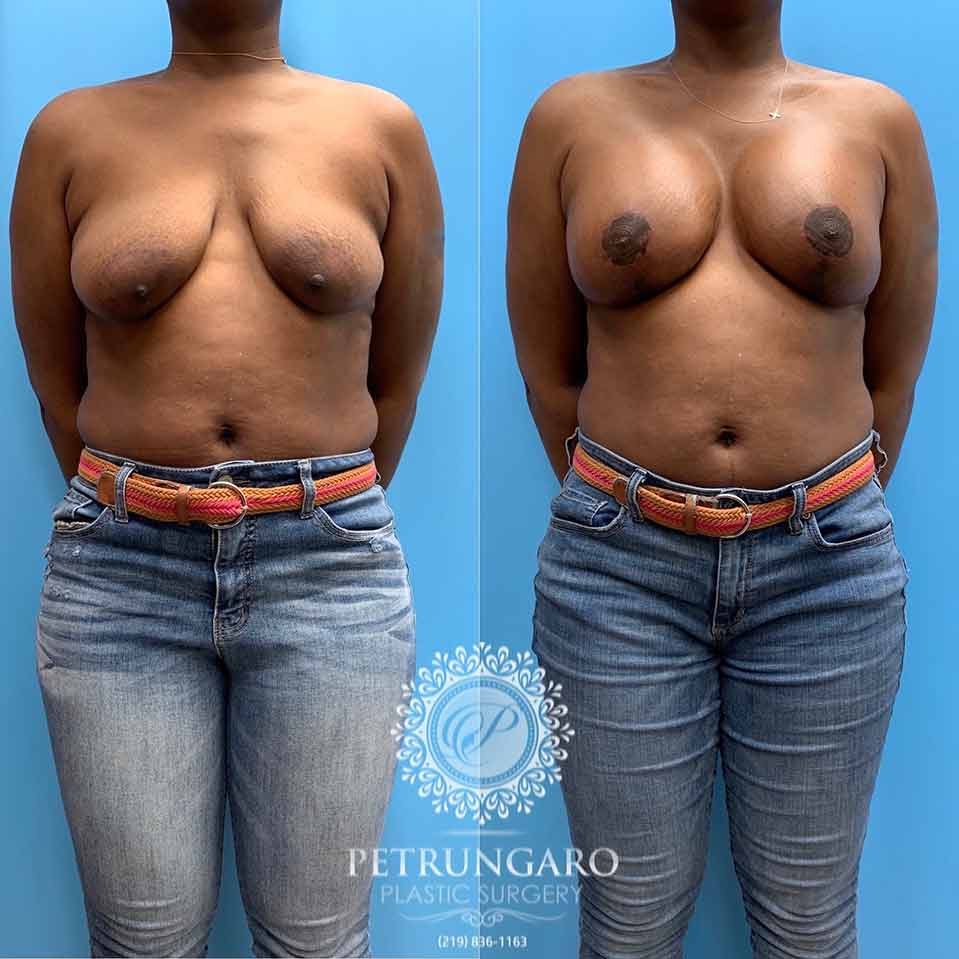https://www.petrungaroplasticsurgery.com/wp-content/uploads/2020/02/41-breast-lift-implants-1.jpg