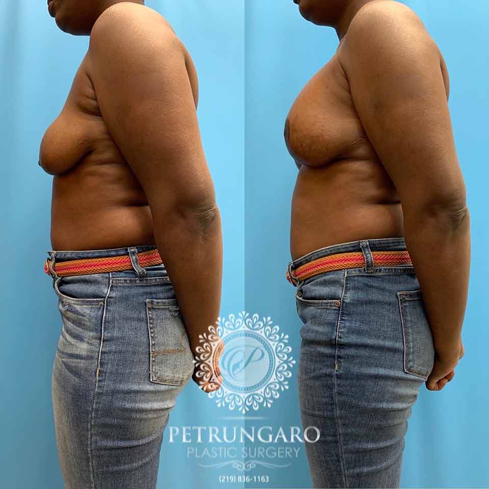 41 Anchor-pattern Breast Lift Aug