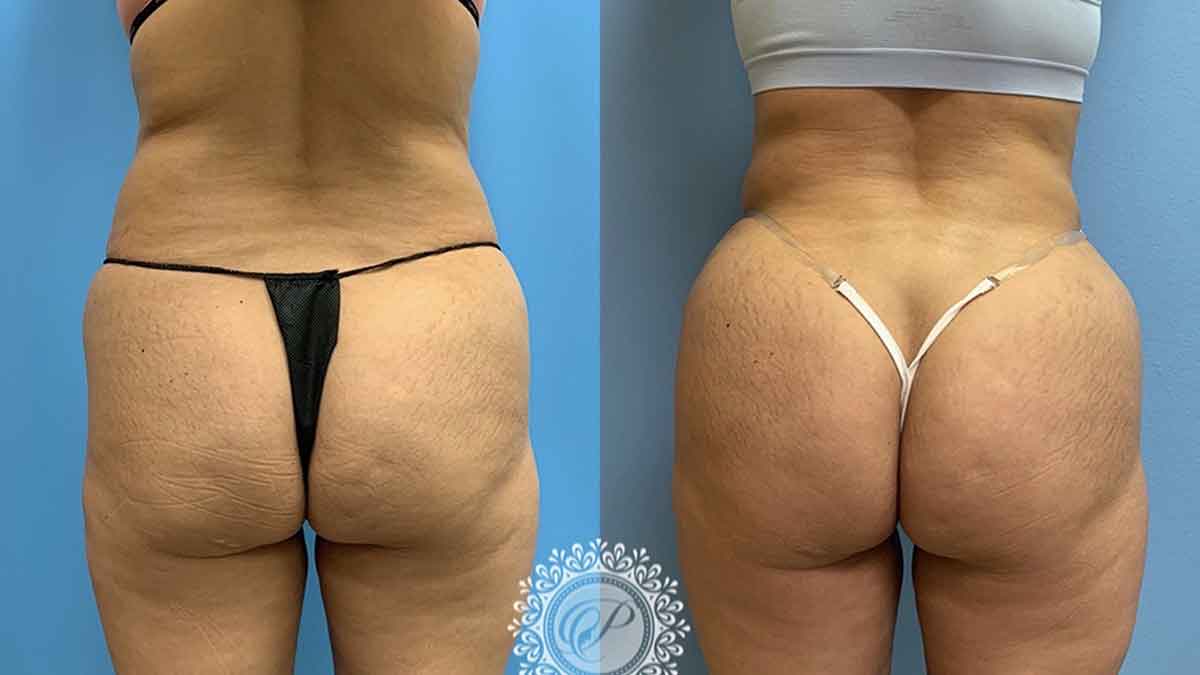 Can I get a Brazilian Butt Lift if I'm overweight? - Liposuction Sydney