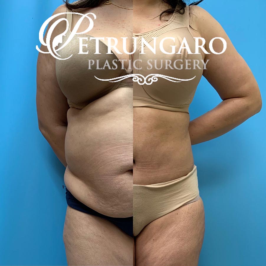 43 F After Liposuction  Petrungaro Plastic Surgery