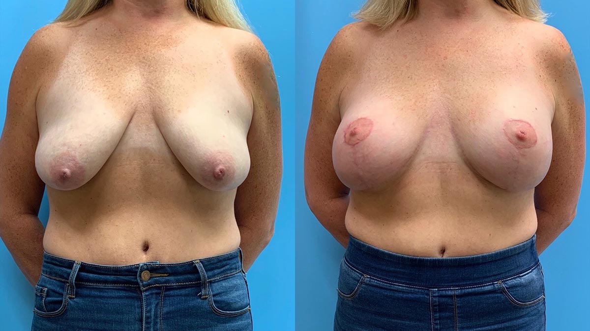 45F 3mths a/ Breast Lift + Implants - Petrungaro Plastic Surgery