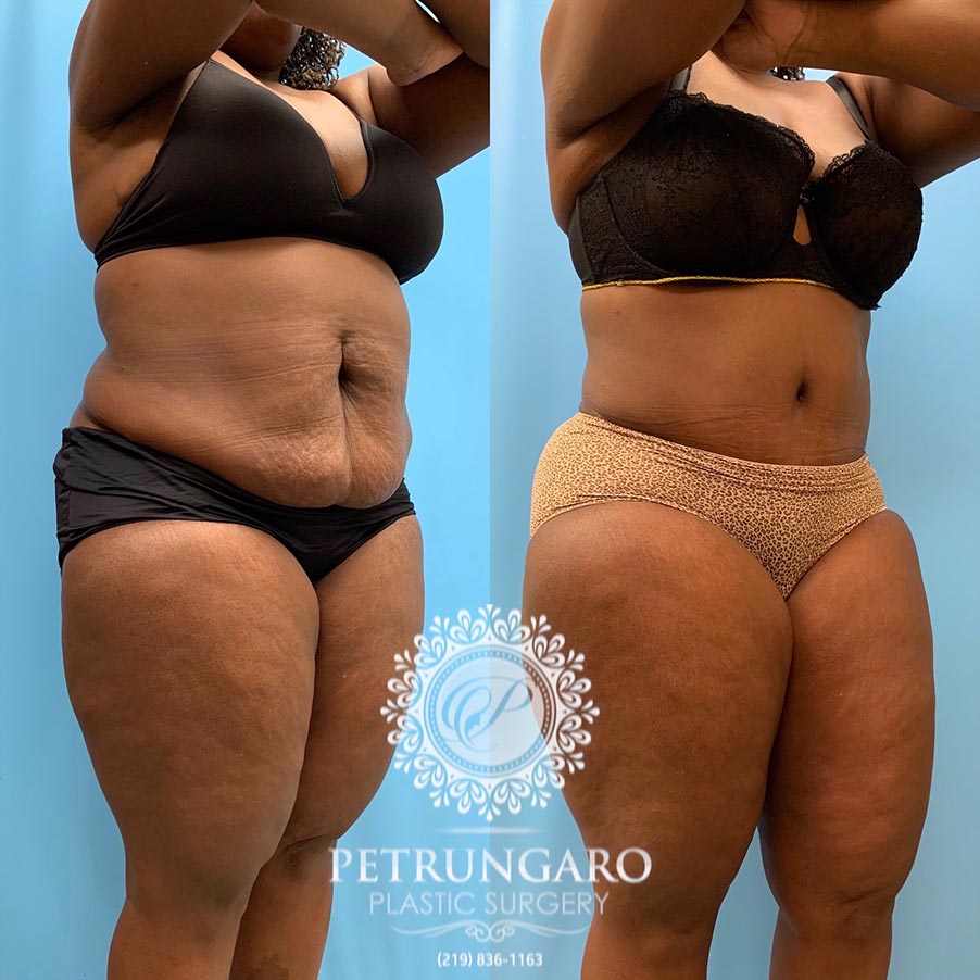49 year old woman 4 months after Tummy Tuck with Lipo 360-4