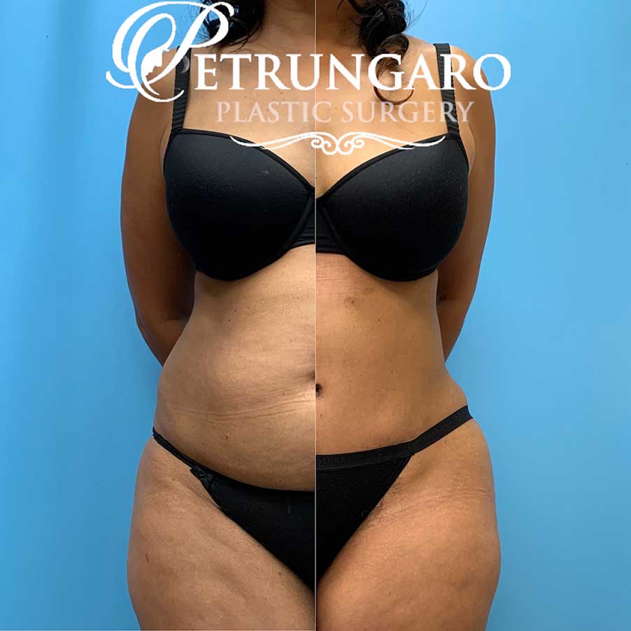 54 F 3 Months After Lipo 360