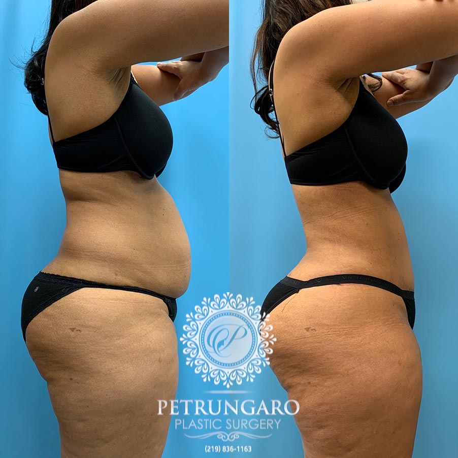 54 year old woman 4 months after Tummy Tuck with Lipo 360-2