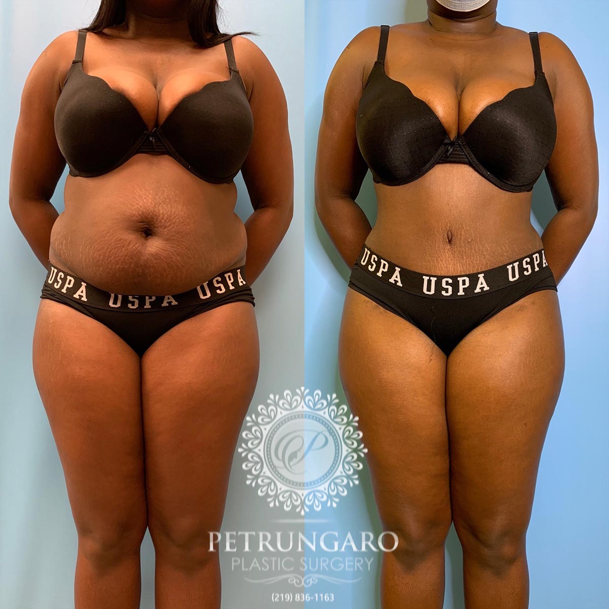 34 female 5 months after Lipo 360