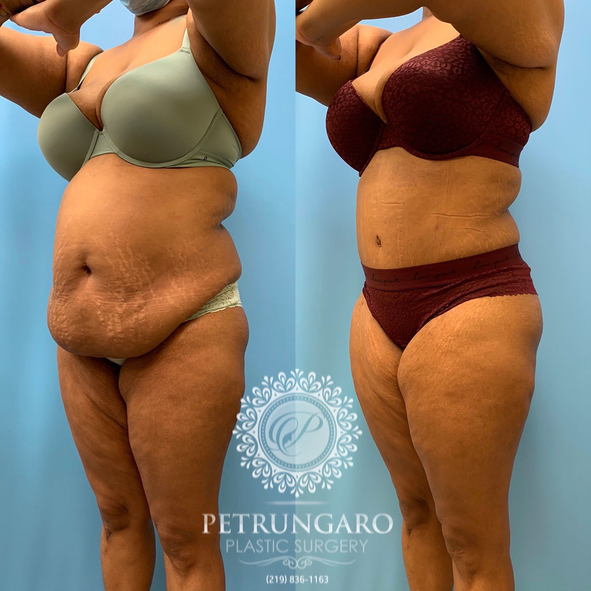 Los Angeles Liposuction Centers on X: Female patient 5 weeks after her  Full Tummy Tuck with Smartlipo 360. Amazing results all with local  anesthesia! Procedure performed by H. Mirzania, MD. #fulltummytuck # tummytuck #