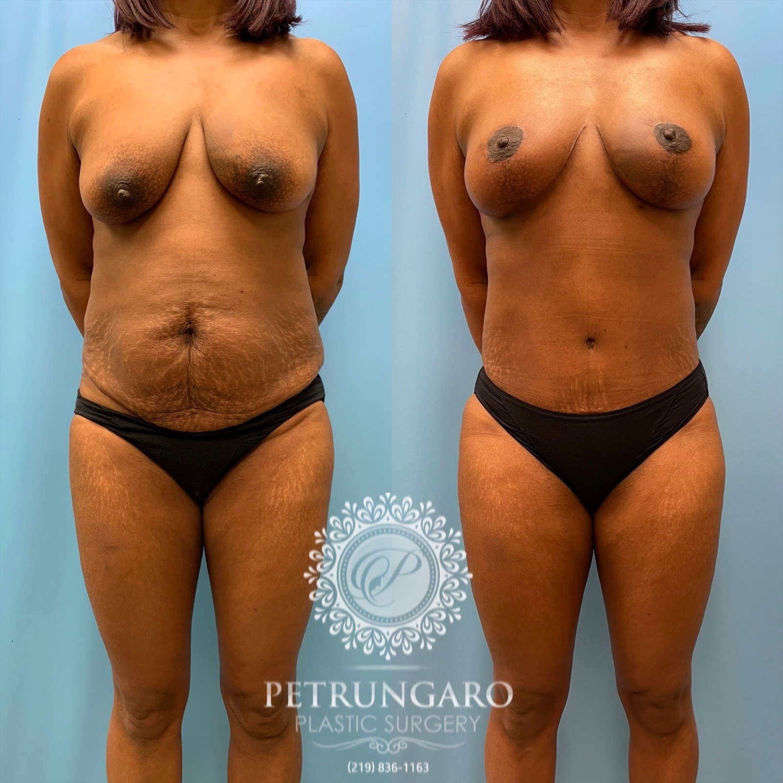 43 year old woman 3 months after Mommy Makeover-1