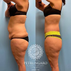 Fleur-de-lis-body-lift-2