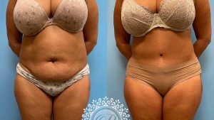 Tummy Tuck Chicago NW Indiana, Costs