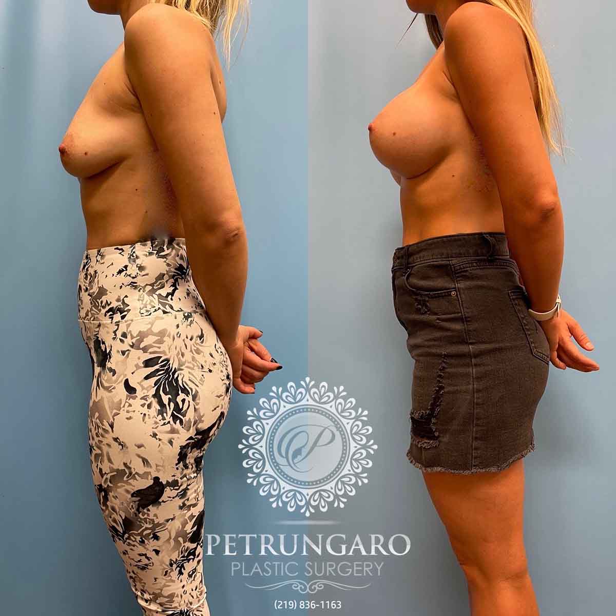 breast-augmentation-natrelle-inspira-before-after-2