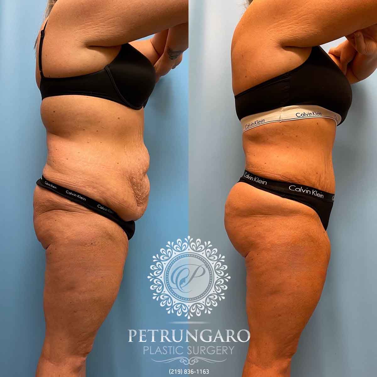 tummy-tuck-liposuction-360-brazilian-butt-lift-3