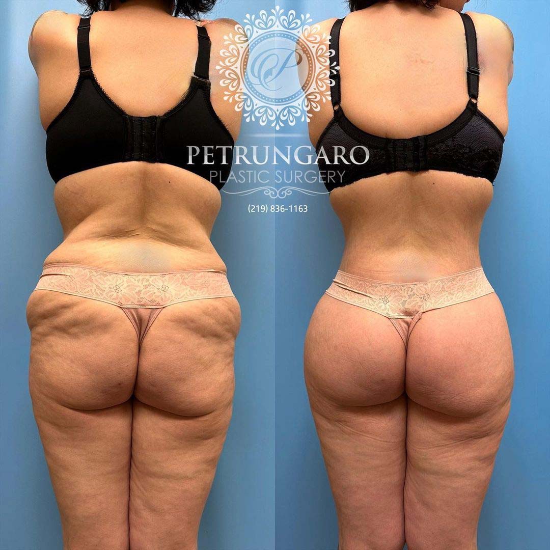 https://www.petrungaroplasticsurgery.com/wp-content/uploads/2023/04/body-lift-Lipo-360-Renuvion-skin-tightening-and-fat-transfer-3.jpg