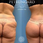 body lift, Lipo 360, Renuvion skin tightening and fat transfer featured image