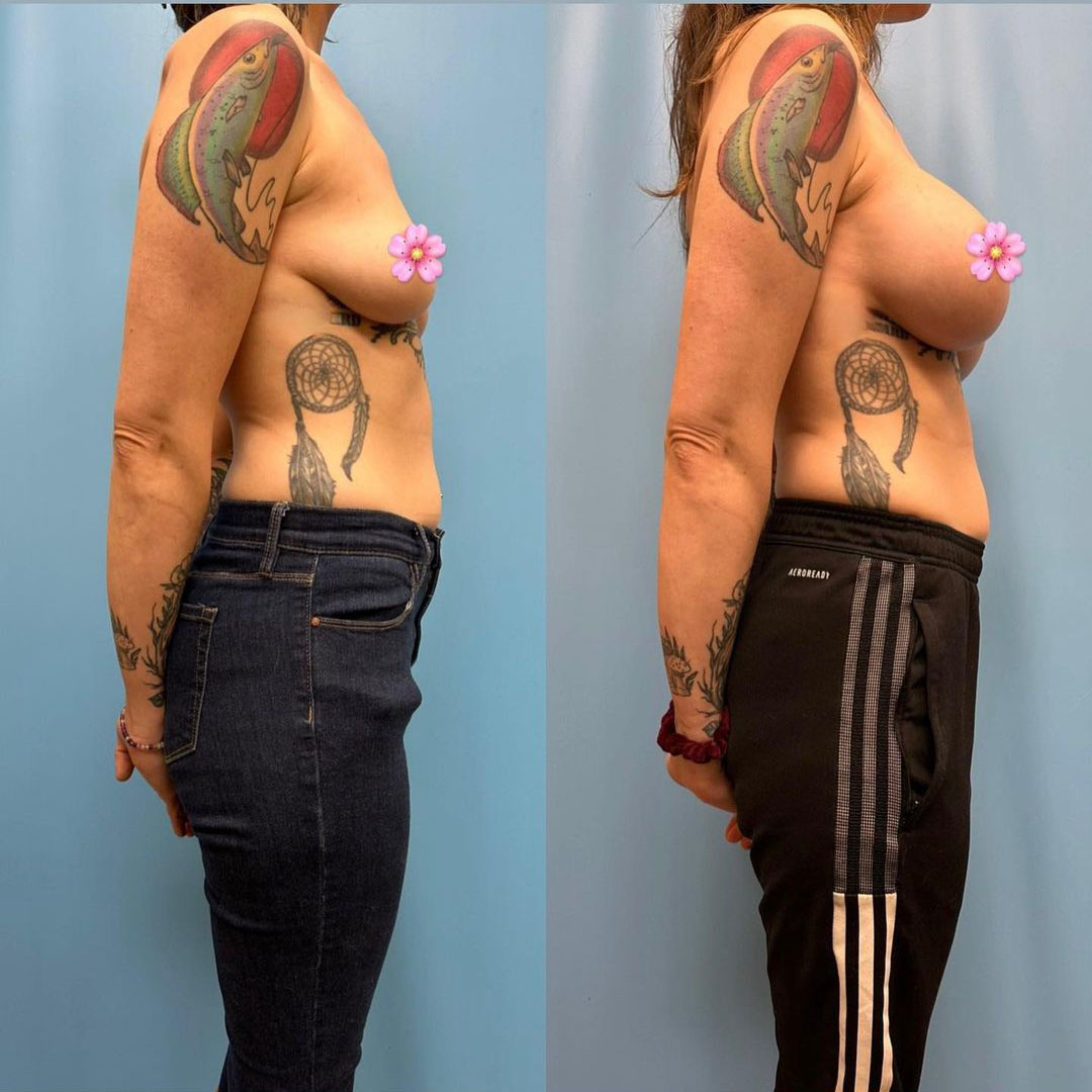 breast-augmentation-before-after-5