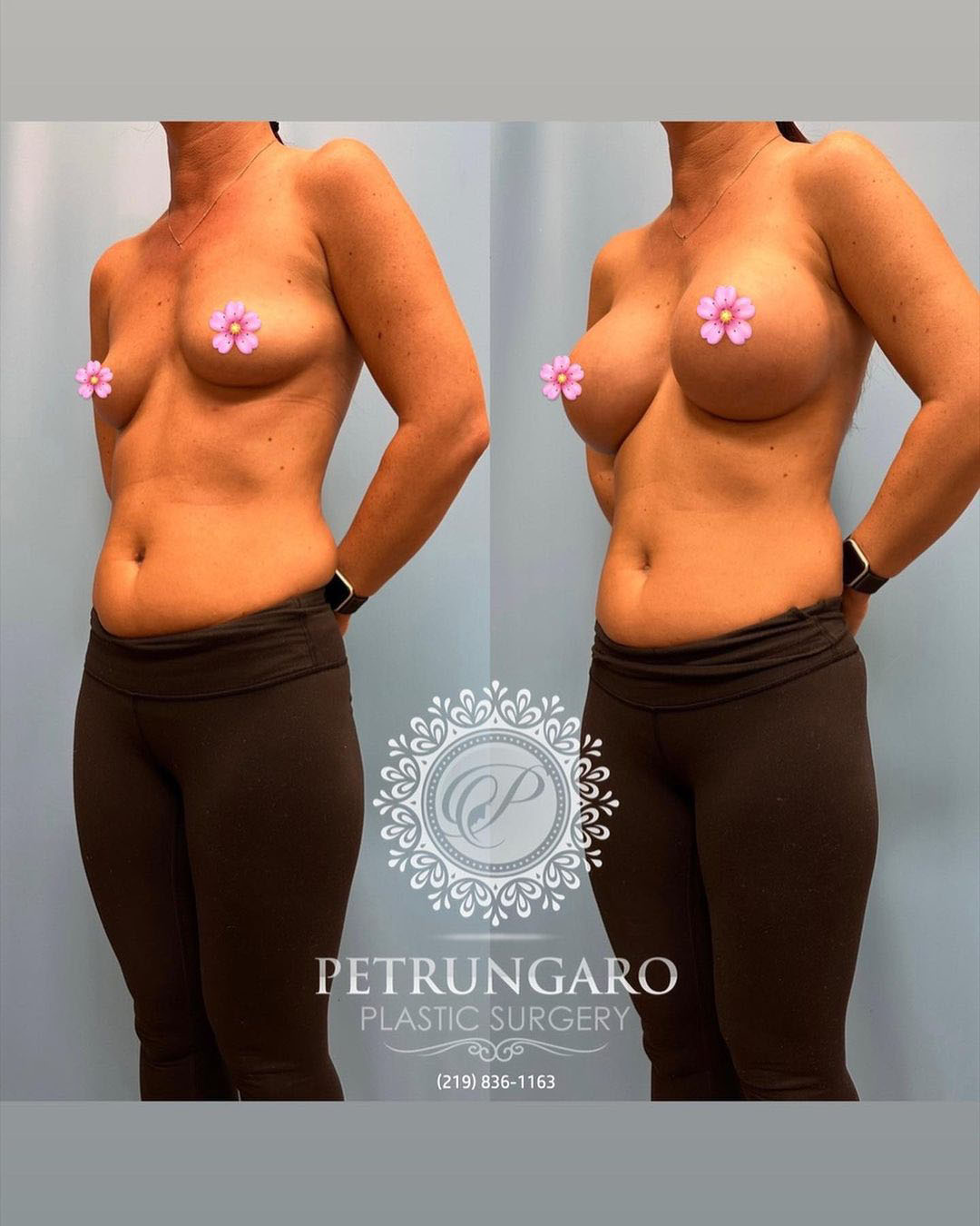 breast-augmentation-2-before-after