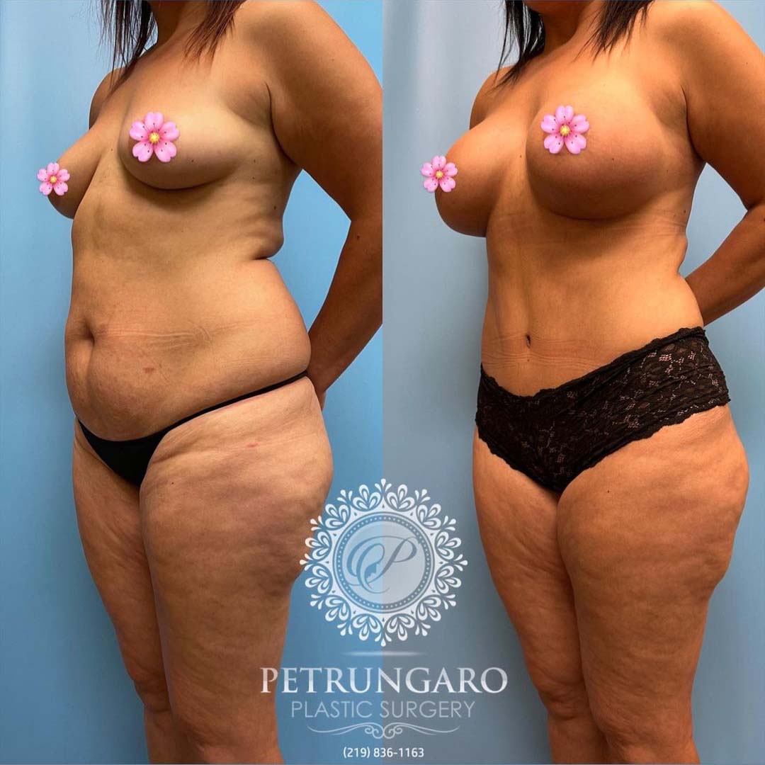 periareolar-donut-breast-lift-with-implants-tummy-tuck-with-Lipo-360-4
