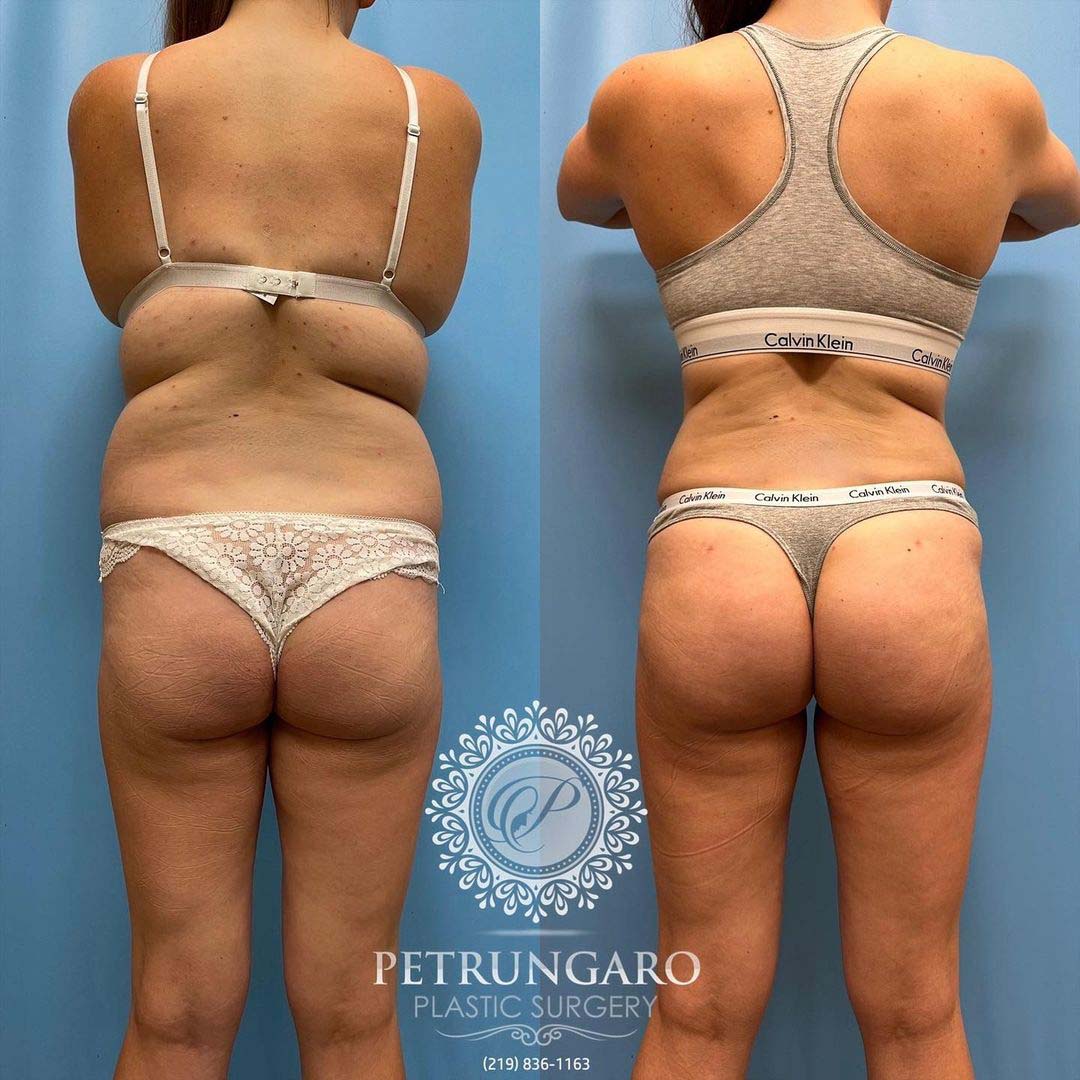 tummy tuck - Lipo 360 - Brazilian Butt Lift before and after -6