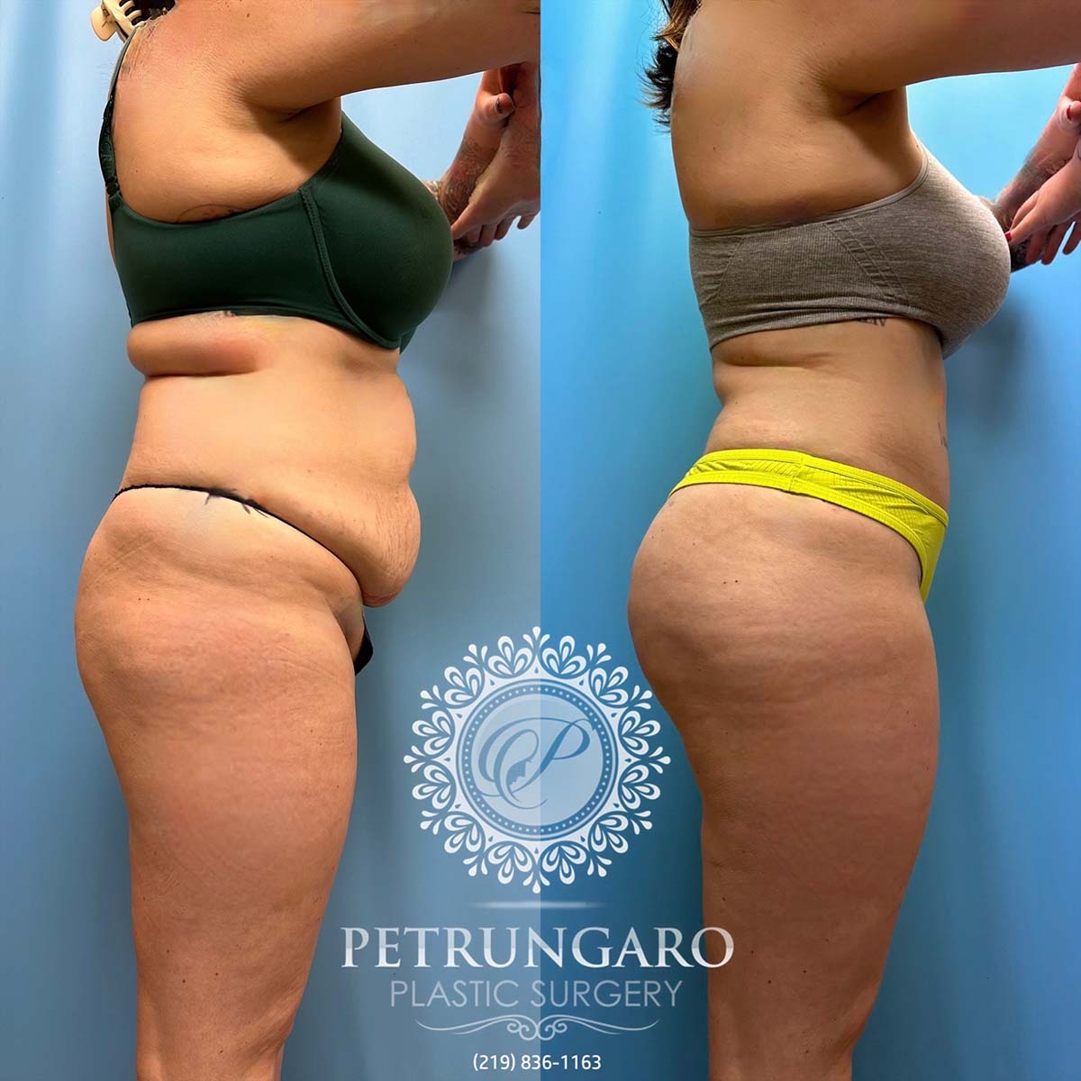 Plastic Surgery Fujairah, Brazilian Butt Lift, Liposuction, Body  Contouring, Tummy Tuck, Arm Lift