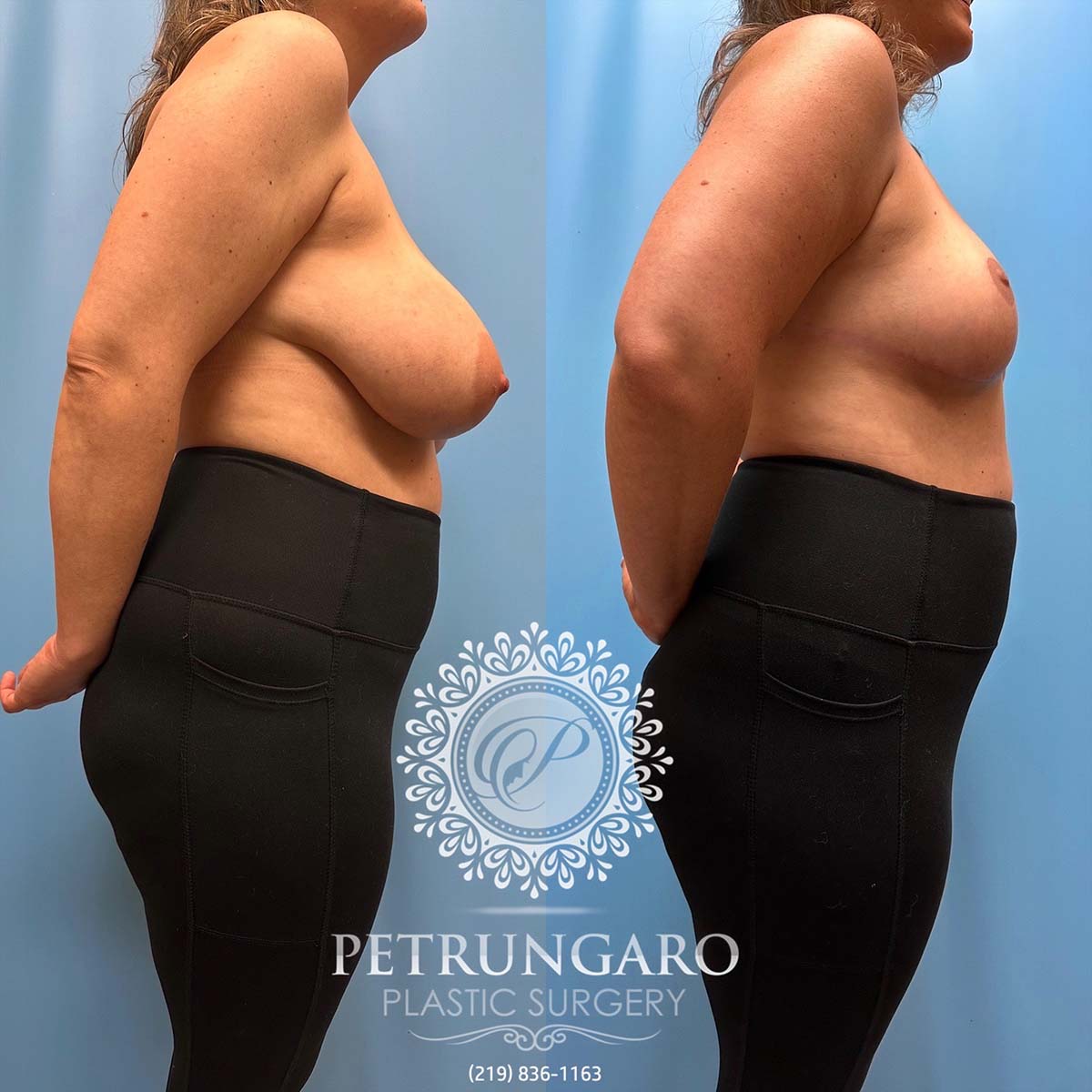 Breast Reduction  Petrungaro Plastic Surgery