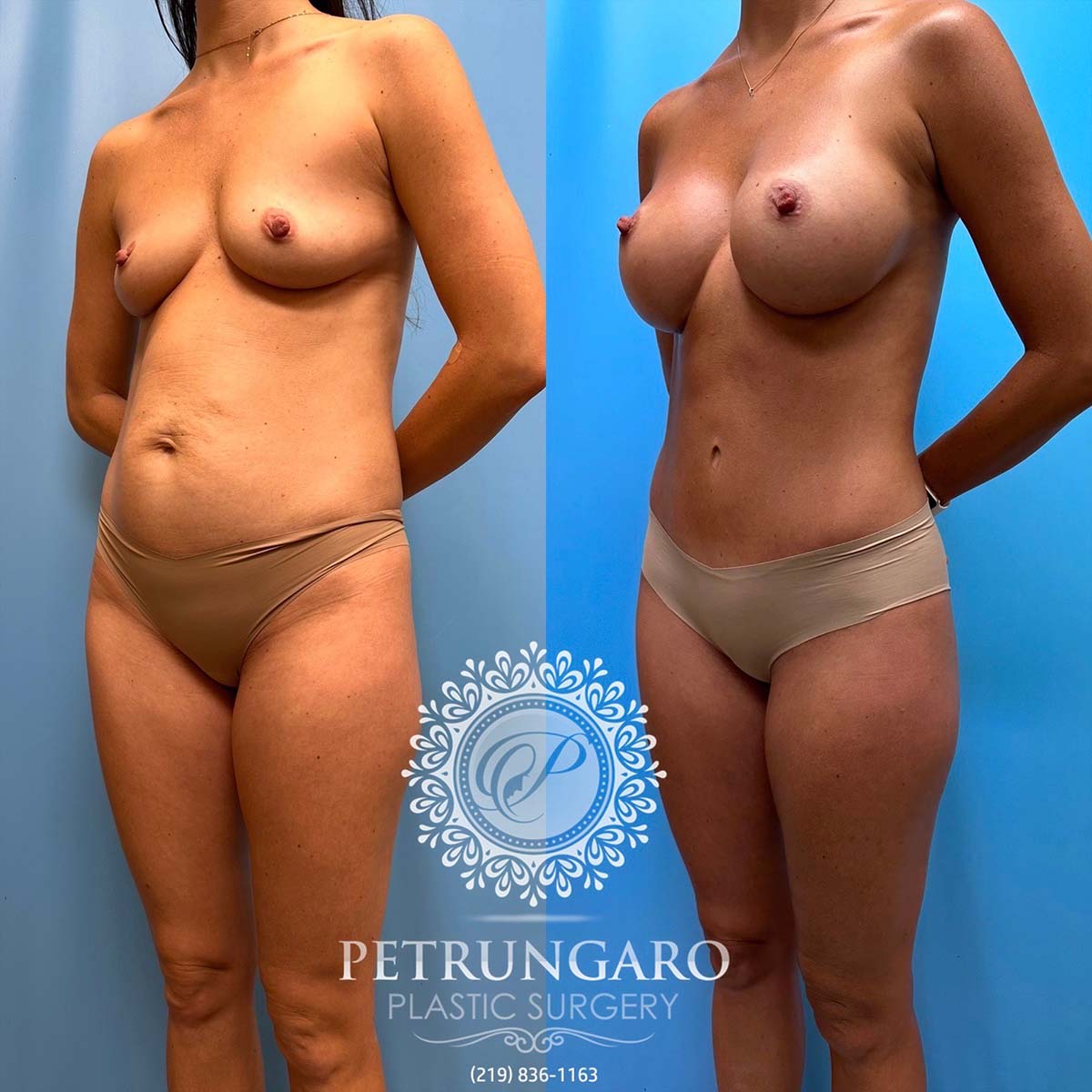 37-f-mommy-makeover-tummy-tuck-liposuction-breast-augmentation-5