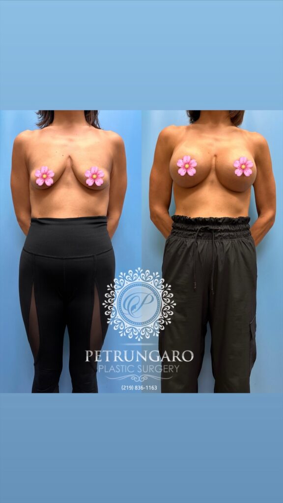 breast lift surgery