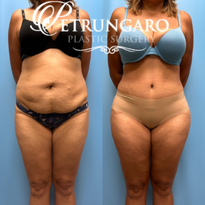 44F Brazilian-Butt-Lift-Lipo-360-&-Renuvion