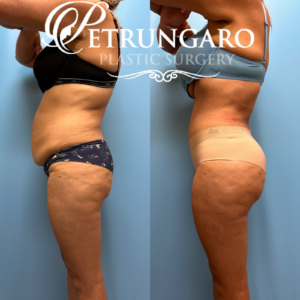 44F Brazilian-Butt-Lift-Lipo-360-&-Renuvion