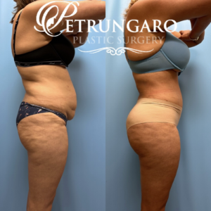 44F Brazilian-Butt-Lift-Lipo-360-&-Renuvion