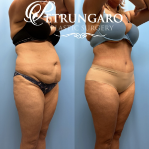 44F Brazilian-Butt-Lift-Lipo-360-&-Renuvion