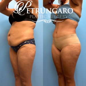 44F Brazilian-Butt-Lift-Lipo-360-&-Renuvion