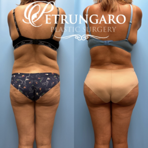 44F Brazilian-Butt-Lift-Lipo-360-&-Renuvion