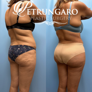 44F Brazilian-Butt-Lift-Lipo-360-&-Renuvion