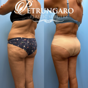 44F Brazilian-Butt-Lift-Lipo-360-&-Renuvion