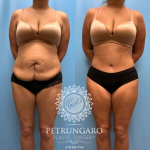 38F-Lipo-360-&-Renuvion