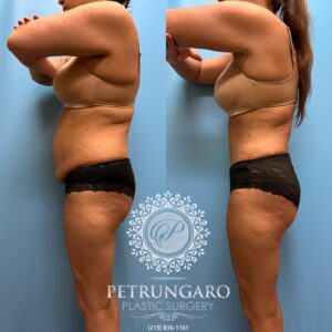 38F-Lipo-360-&-Renuvion