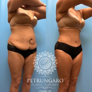 38F-Lipo-360-&-Renuvion