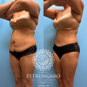 38F-Lipo-360-&-Renuvion