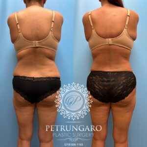 38F-Lipo-360-&-Renuvion