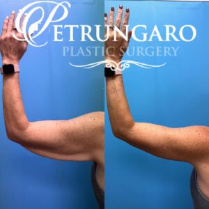 50F-Year-Old-Woman-Before-and-After-Extended-Arm-Lift