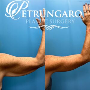 50F-Year-Old-Woman-Before-and-After-Extended-Arm-Lift