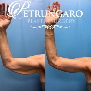 50F-Year-Old-Woman-Before-and-After-Extended-Arm-Lift