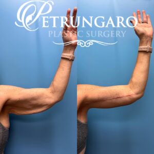 50F-Year-Old-Woman-Before-and-After-Extended-Arm-Lift