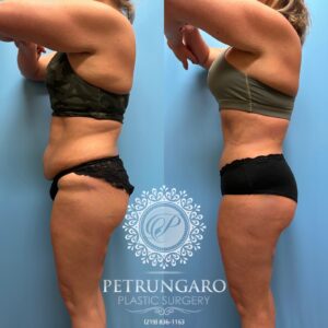 39F-Tummy-tuck-Lipo-360-&-Renuvion