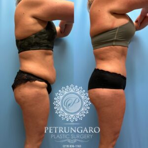 39F-Tummy-tuck-Lipo-360-&-Renuvion